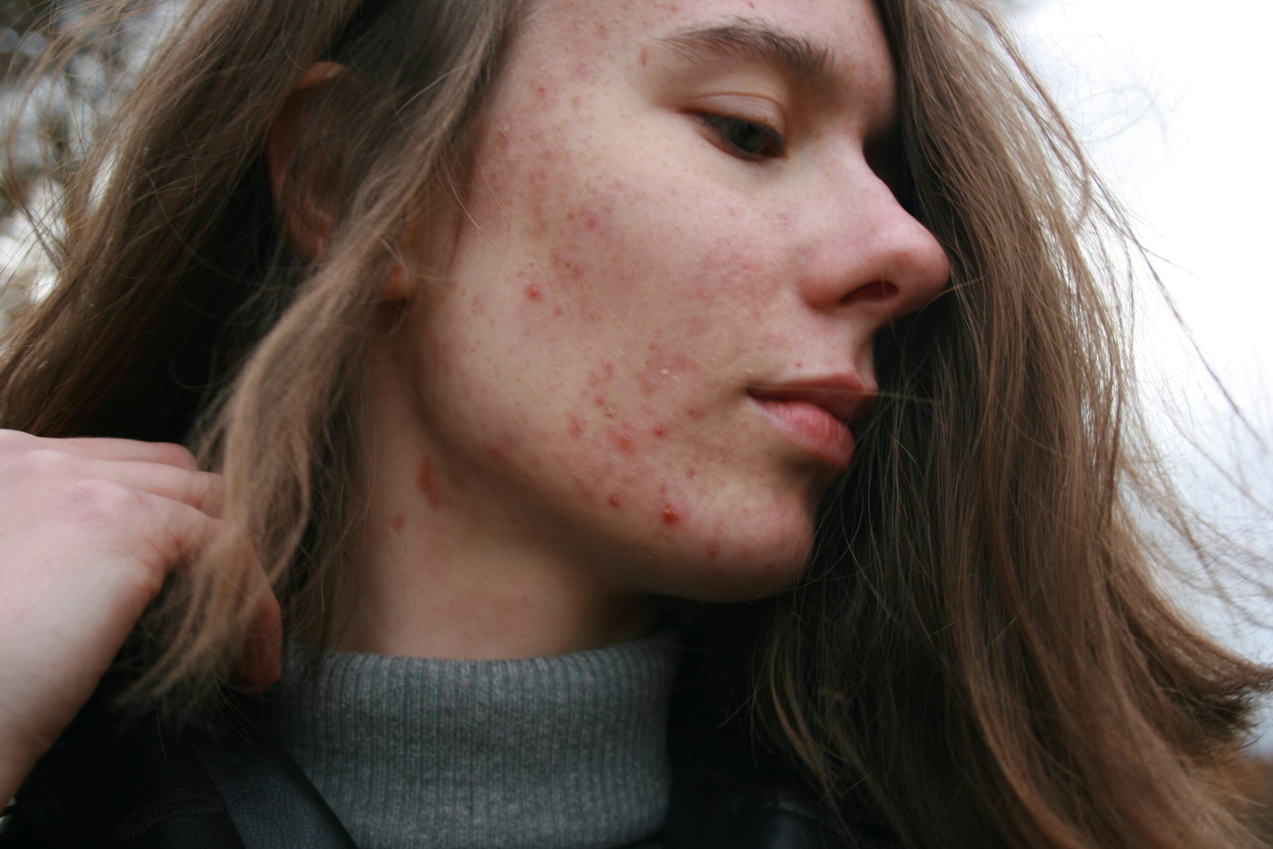 girl with acne