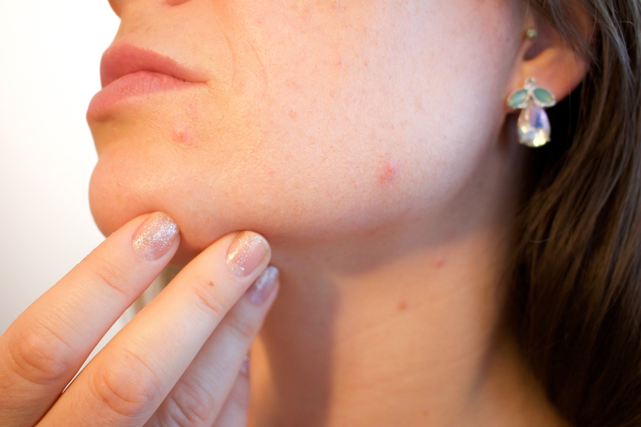 home remedies for acne image