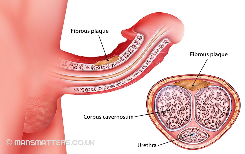 peyronies disease