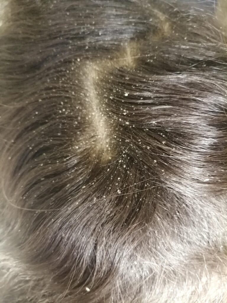 dandruff