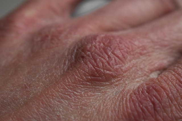 dry skin